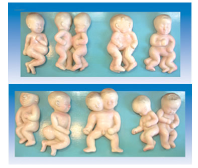 胎儿畸型模型