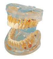 透明牙体病理模型