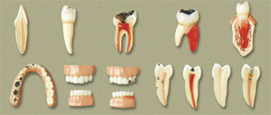 牙齒病變系列模型