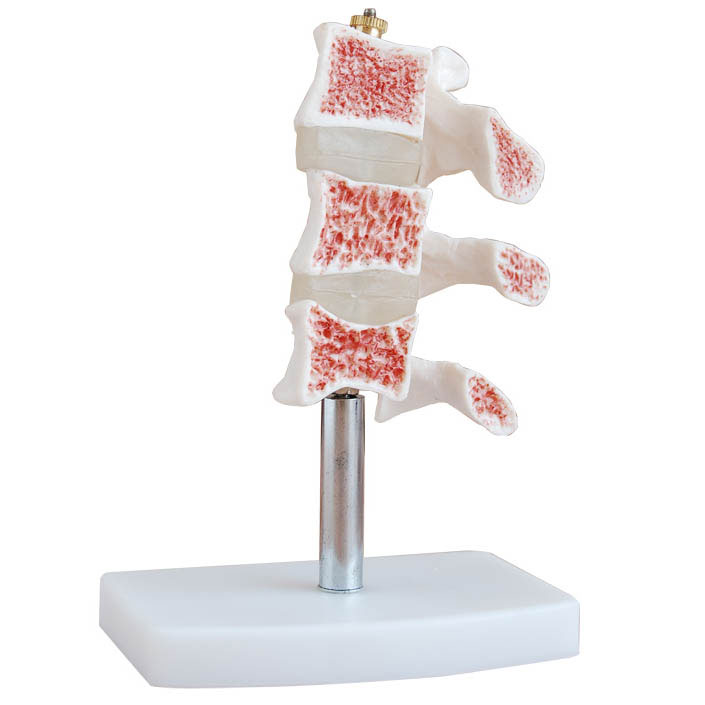 骨质疏松症模型
